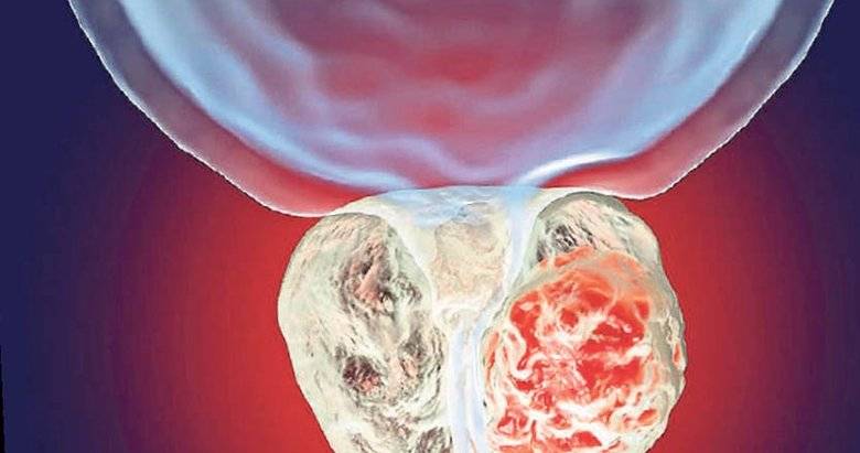 Her 8 erkekten 1’inde var! İşte erkeklerin bilmesi gereken prostat gerçekleri 6