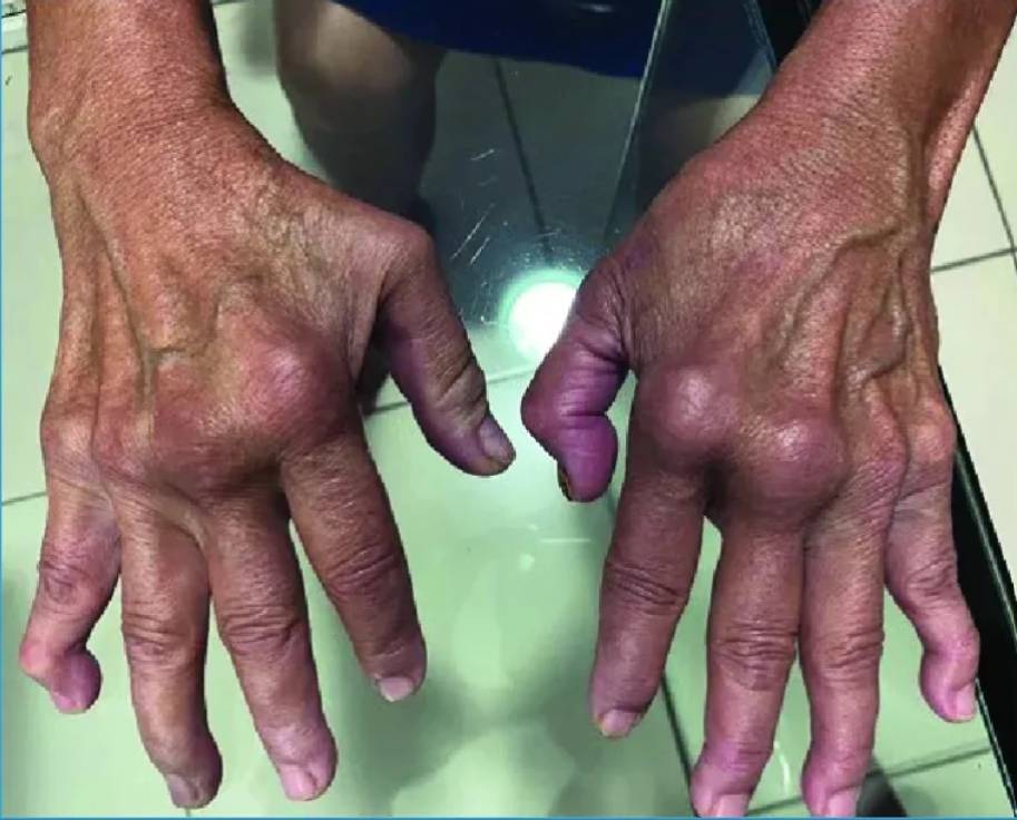 “İkiye Katlanmış Eller” salgını giderek büyüyor! Chikungunya virüsü dünyayı tehdit ediyor 2