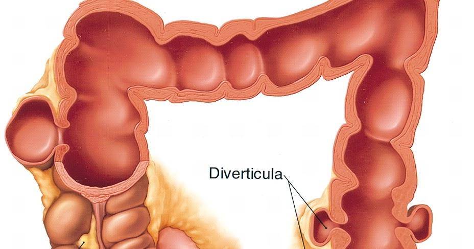 Her 3 kişiden 2’si lif eksikliği yaşıyor: Bağırsaklarda divertiküler hastalık gençlerde de artıyor! 5