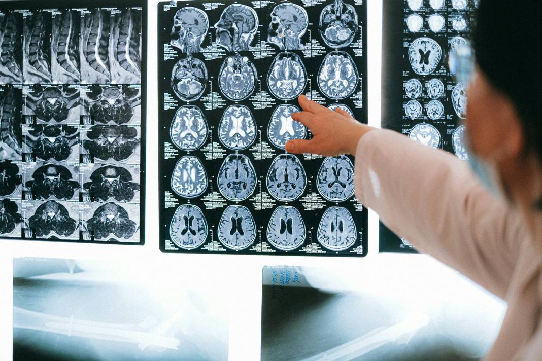 Beyni genç tutan alışkanlık ortaya çıktı! Alzheimer ve demans riskini yüzde 22 azaltıyor 8