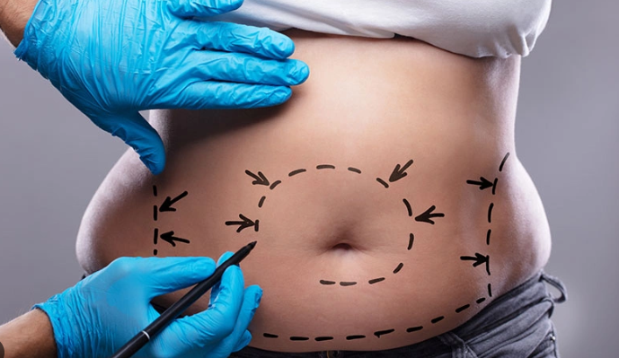 Liposuction hakkında doğru bilinen yanlışlar