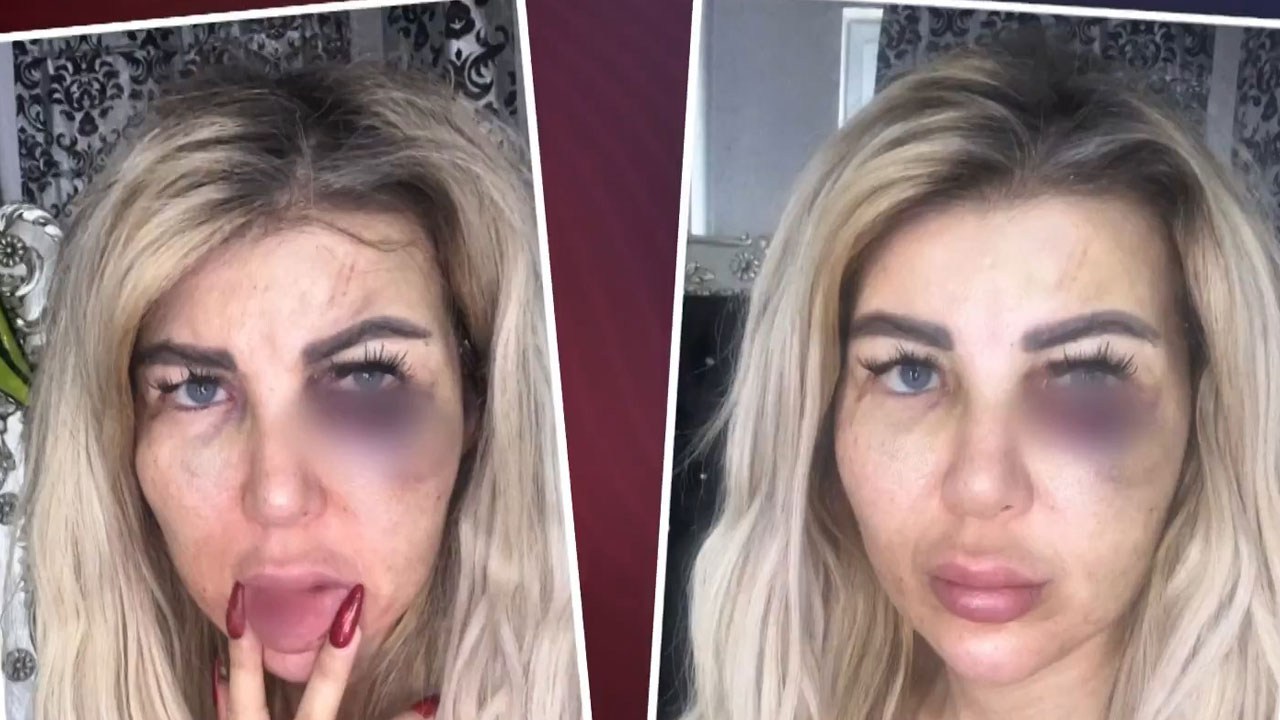 Danla'nın tokat olayı sonrası karar verdi! Müzisyen Nazlı Hamarat erkek arkadaşı tarafından dövüldü