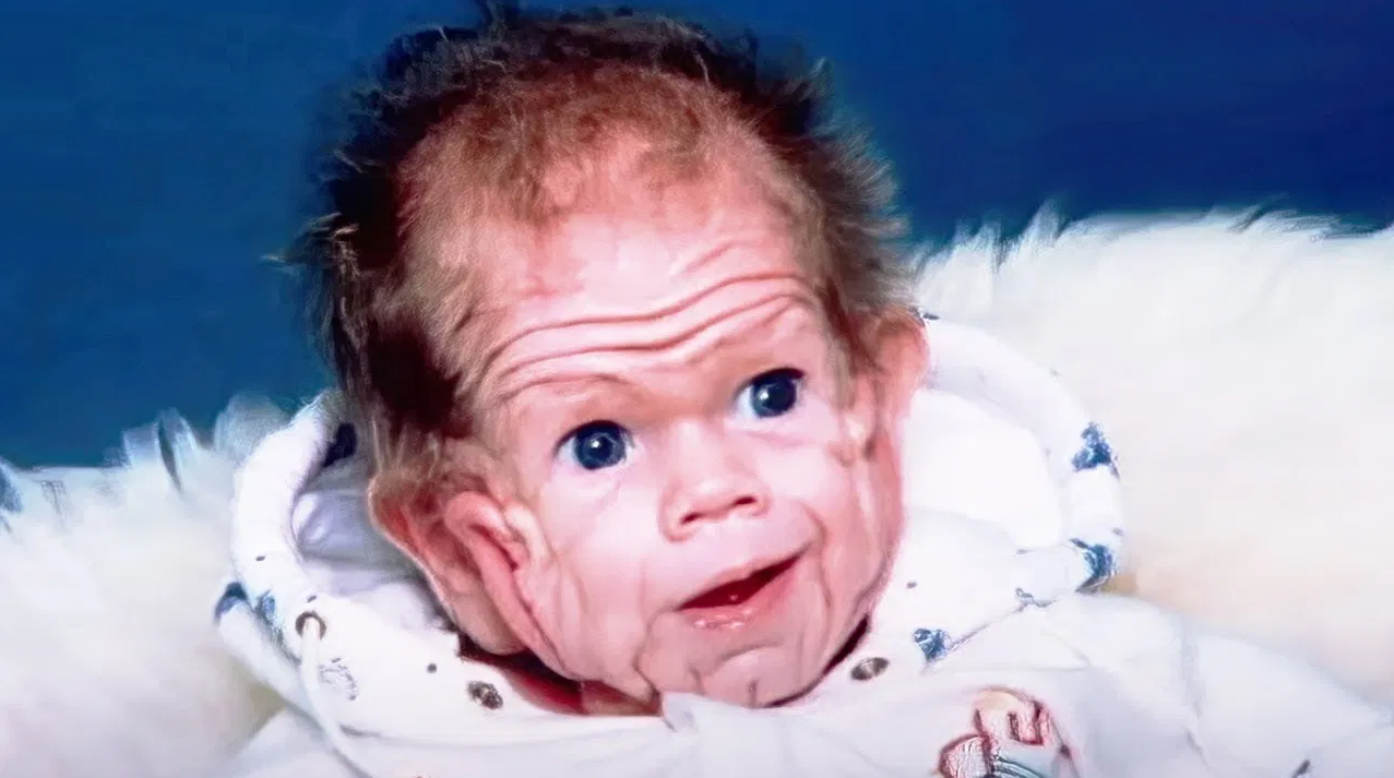 İşte yaşayan Benjamin Button! Dünyayı hayrete düşüren bebek: Yaşlı bir halde dünyaya geldi!