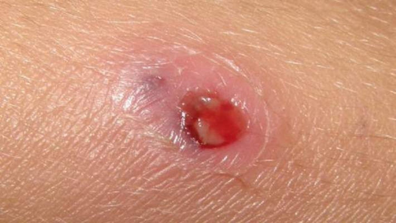 Belirti bile vermeden ortaya çıkıyor: Chagas hastalığı ölümcül risk taşıyor!