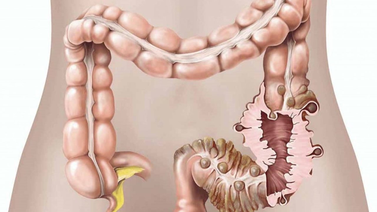 Her 3 kişiden 2’si lif eksikliği yaşıyor: Bağırsaklarda divertiküler hastalık gençlerde de artıyor!