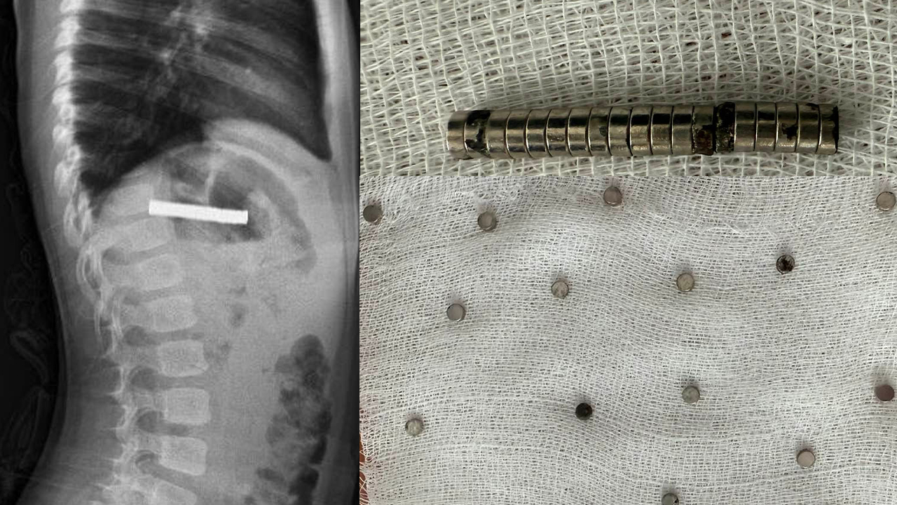 Elazığ’da 3 yaşındaki bir çocuğun yemek borusundan 19 tane mıknatıs çıktı!