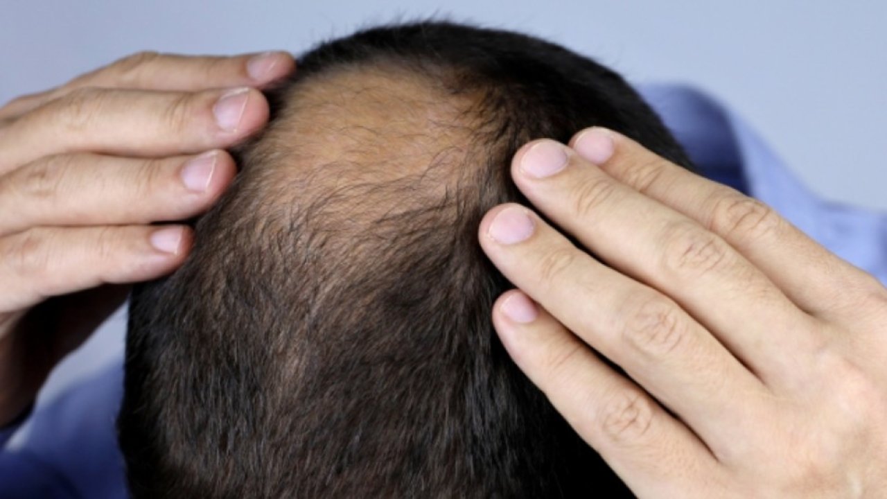 Saç dökülmesine karşı yeni devrim: Dökülmeyi durdurmanın sırrı basit bir şekerde gizli olabilir!