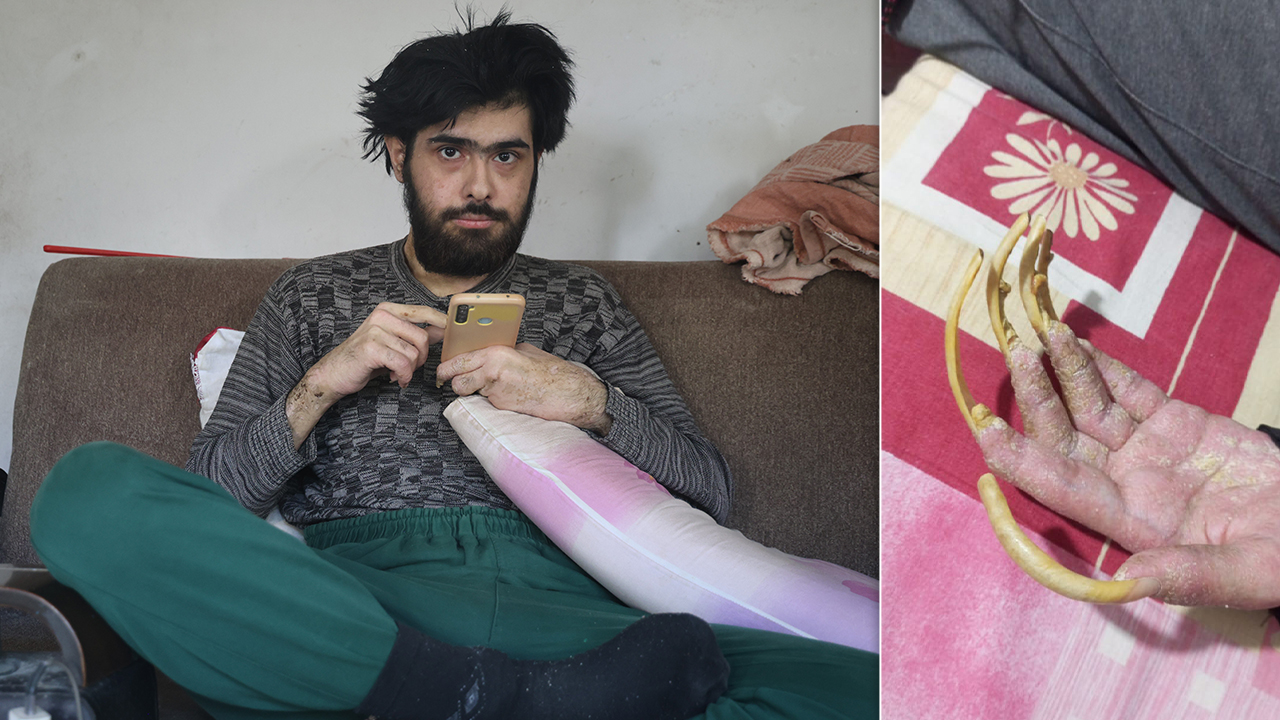 Sosyal medyada gündem olmuştu! 3 yıldır telefona bağlı yaşayan gencin önceki hali şoke etti