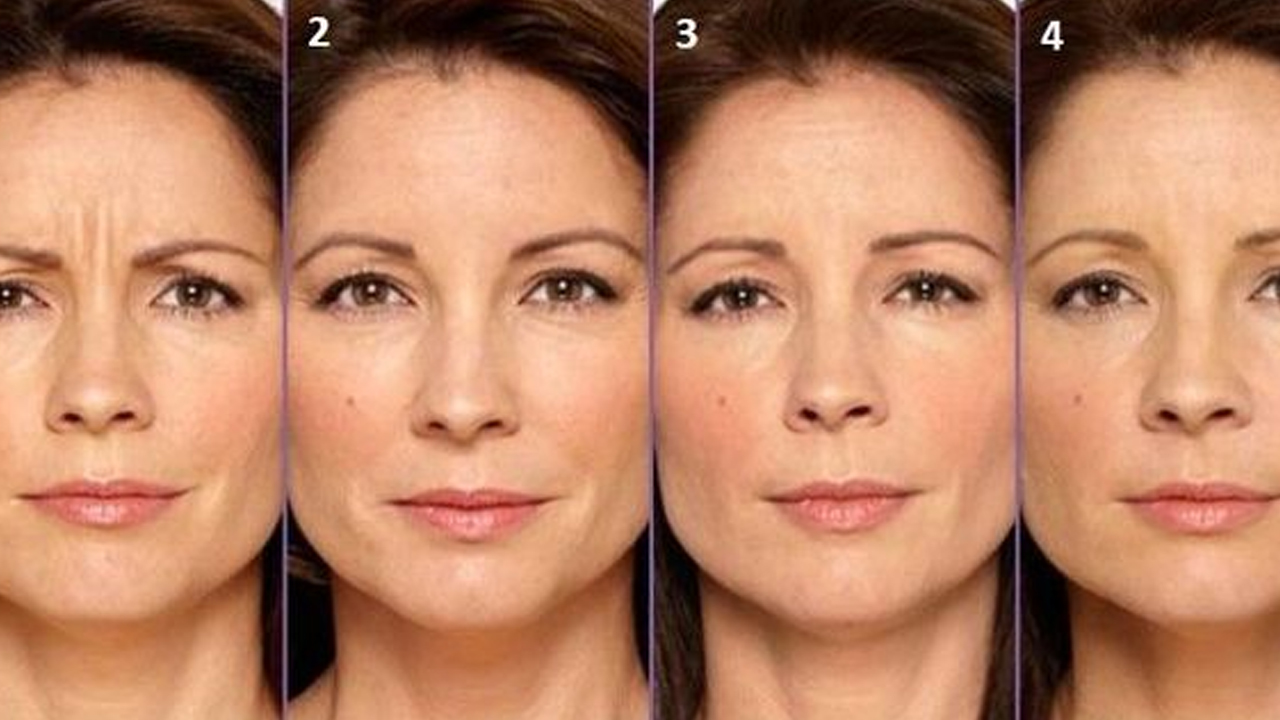 Sosyal medya erozyonu bunu da getirdi! Botoks yaşı 15'e düştü