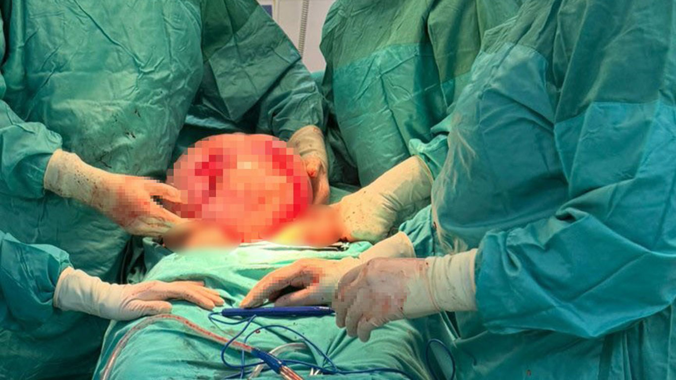 Karnı 2 ayda 9 aylık hamile gibi büyümüştü: 30 santim çapında, tam 8.5 kiloluk kitle...