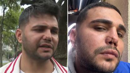 Burun ameliyatı kabusa dönüştü: 7 yılda 5 kez operasyon geçirdi, aynaya bakamaz hale geldi