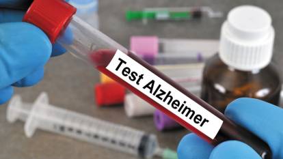 Alzheimer’a yeni umut: Devrim yaratan testle Alzheimer tanısı artık daha kolay olacak