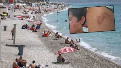 Denize giren kızarıklıkla çıkıyor! Hastaneler doldu taştı: İşte nedeni…