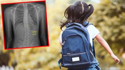 Okul çantası yüzünden skolyoz oldu: İki kez ameliyat olmuştu, hastalık yeniden nüksetti!