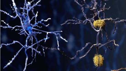 Alzheimer’ın gizli suçlusu beyin otopsilerinde ortaya çıktı: Alzheimer’a katkıda bulunan hücreler ilk kez tanımlandı