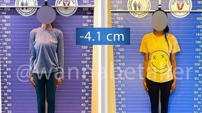 Boy kısaltma için Türkiye'ye akın ettiler: Yabancıların ilginç trendi!