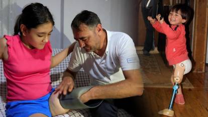 Küçük Özge’nin umudu 24 saatte yeşerdi: Yeni protez için hayırseverler seferber oldu!