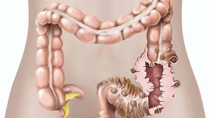 Her 3 kişiden 2’si lif eksikliği yaşıyor: Bağırsaklarda divertiküler hastalık gençlerde de artıyor!
