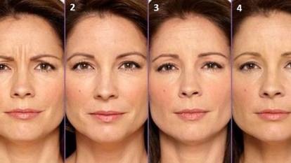 Sosyal medya erozyonu bunu da getirdi! Botoks yaşı 15'e düştü