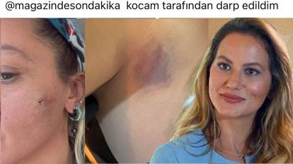 Ünlü oyuncu Yıldız Asyalı'nın sosyal medya paylaşımı gündem oldu! "Kocam tarafından darp edildim"