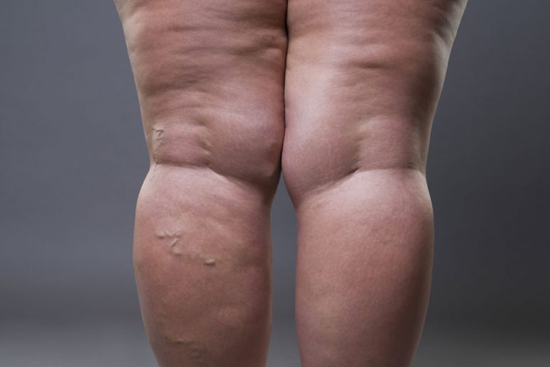 lipodem.jpg