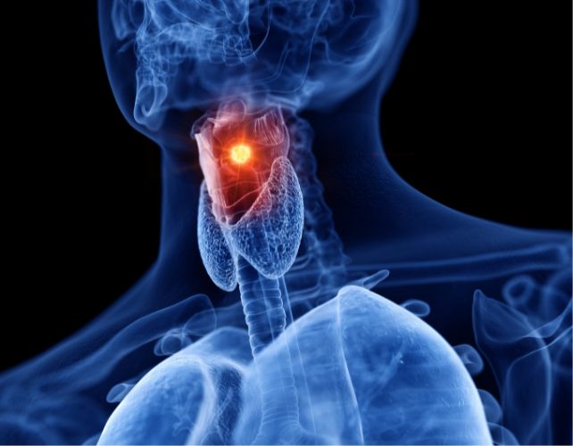 laryngeal-cancer.jpg